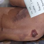 Kecelakaan Kerja Kembali Terjadi di Tambang Konut, Korban Meninggal Dunia